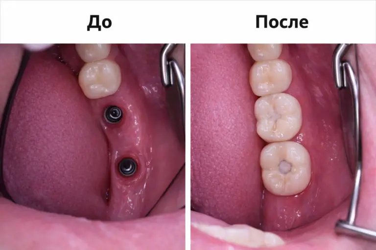 Клинический случай имплантации 6 и 7 зубов