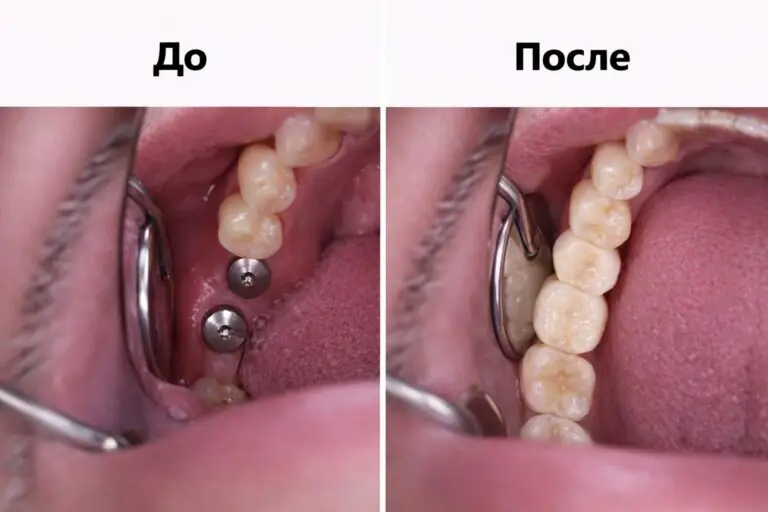 Клинический случай одномоментной имплантации 4.6 и 4.7